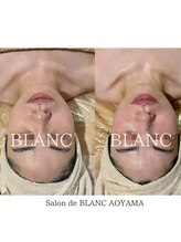 サロン ド ブラン アオヤマ(Salon de BLANC AOYAMA)/ビオフィート×ソノケア