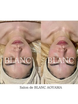 サロン ド ブラン アオヤマ(Salon de BLANC AOYAMA)/ビオフィート×ソノケア
