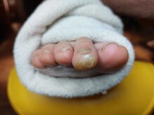 爪切り屋 足楽/ゆびさきの角質