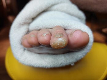 爪切り屋 足楽/ゆびさきの角質