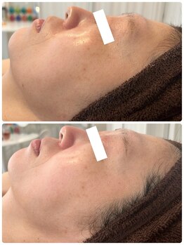 グラサヴォーグ 金沢店/顎が違う◎白さ透明感が違う♪