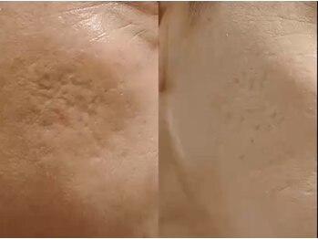 ホームサロンルビー(Home Salon Ruby)/ルンメディオダイヤモンド