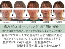 スフレ(souffle)の雰囲気（骨格から変わる！面長改善、中顔面短縮、エラ張り、左右差改善）