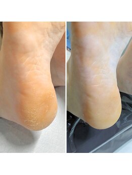 ドクターネイル爪革命 小田原鴨宮店/角質ケア（スクラブ付き）