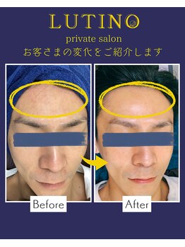 ルチノ(LUTINO)/シワ・トーンアップ40代6回