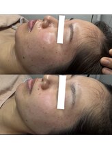 ベラピエル(BELLA Piel)/ビフォーアフター