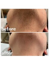 ベイス(BASE)/ヒゲ脱毛BeforeAfter