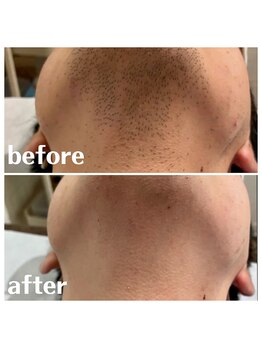 ベイス(BASE)/ヒゲ脱毛BeforeAfter