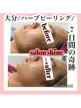 サロンシャイン(Salon Shine)/ハーブピーリング７日間