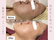 ルア(LuA.)/剥離ありリベルハーブピーリング