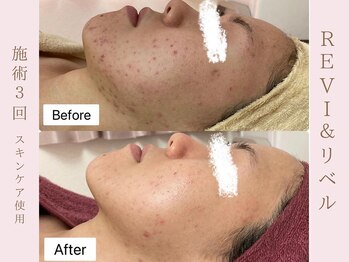 ルア(LuA.)/剥離ありリベルハーブピーリング