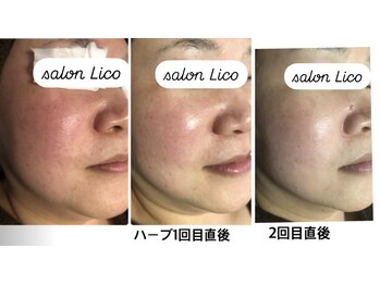 リコ(Lico)/赤らケア