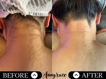 アングレイス(Anngrace)/【全身脱毛うなじ】Before/After
