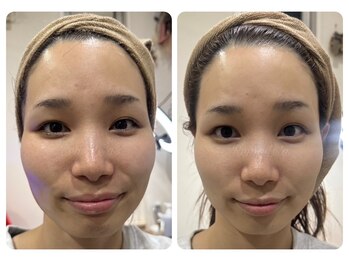 リモレア(RemoLe'a)/美顔筋テラボーラー