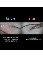 マナワ(manawa)/ヘッドスパ施術 before→after