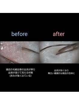 マナワ(manawa)/ヘッドスパ施術 before→after