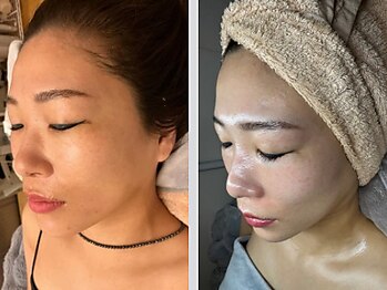 エムエー(MA)/水光ピール