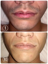 サロンエヌ 久留米店(Salon N)/ヒゲ脱毛before/after