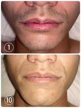 サロンエヌ 久留米店(Salon N)/ヒゲ脱毛before/after