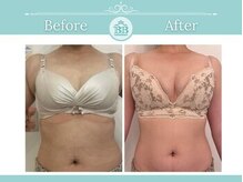 美人バスト 新潟店/ 【バストアップ★育乳】症例