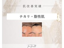 スリースリー 恵比寿(THREE THREE)/テカリ・脂性肌ケア改善実績写真