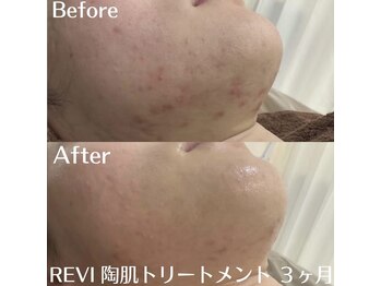 ホワイトアクア 中目黒店(WHITE AQUA)/ハーブピーリング/毛穴/中目黒