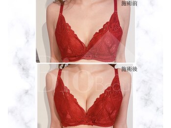 サロン アンネ(Anne)/本格エステ豊胸プログラム