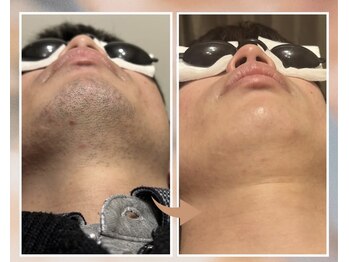 プルベル 平尾(Plus Belle)/ヒゲ脱毛