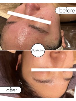 エヌ セレクション(N_selection)/赤み、色ムラを整えます◎