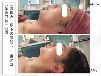 レッド(RED)/短期集中で小顔になれる!