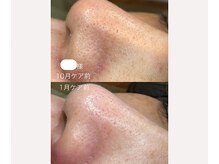 サイ(Sai)/20年来のニキビを改善