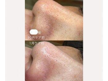 サイ(Sai)/20年来のニキビを改善