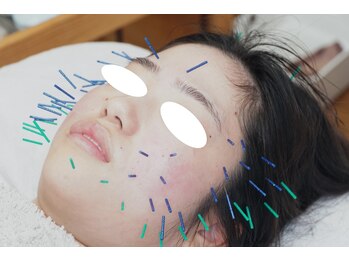 岩川治療院/当院独自の鍼施術