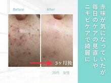 ルナティアラ(LUNAティアラ)/ニキビ・毛穴