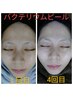 ☆最強の組み合わせ☆ バクピー&光フェイシャル 短期集中ケア5回