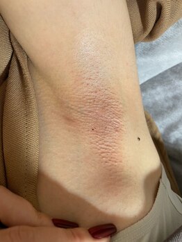 ルルゴ(LULUGO)/両脇ワックス脱毛