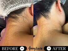 アングレイス(Anngrace)/【全身脱毛うなじ】Before/After