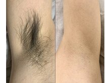 アンドエス 六本木(and S.)/ワックス＋光のW脱毛≪脇脱毛≫