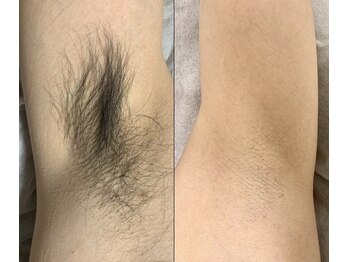 アンドエス 六本木(and S.)/ワックス+光のW脱毛≪脇脱毛≫