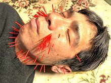 とだ鍼灸院/ほうれい線/二重顎 美容鍼50本◎