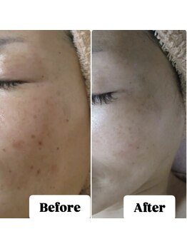 エステルーム アンジュ(Esthe Room Ange)/シミケア/ADSプログラム/