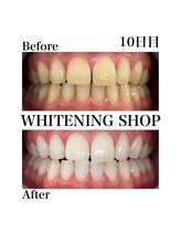 ホワイトニングショップ 西尾店/Before&After　10日目のお客様