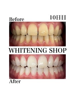 ホワイトニングショップ 西尾店/Before&After 10日目のお客様