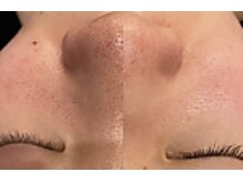 ブリッシュ(Bullish)/毛穴洗浄