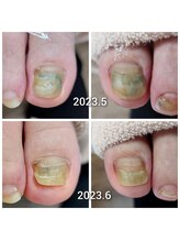 爪切り屋 足楽/爪の伸び　その２