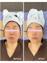 おおむら鍼灸接骨院/フェイシャル Before＆After