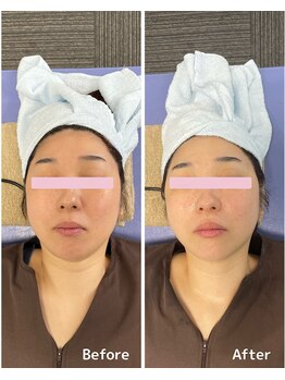 おおむら鍼灸接骨院/フェイシャル Before＆After