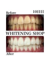 ホワイトニングショップ 西尾店/Before&After　10日目のお客様