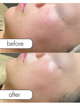 アール(R;)/赤みはお肌の火事