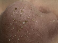 サラグランデ(Sara Grande)/これ全部毛穴の中にいました！